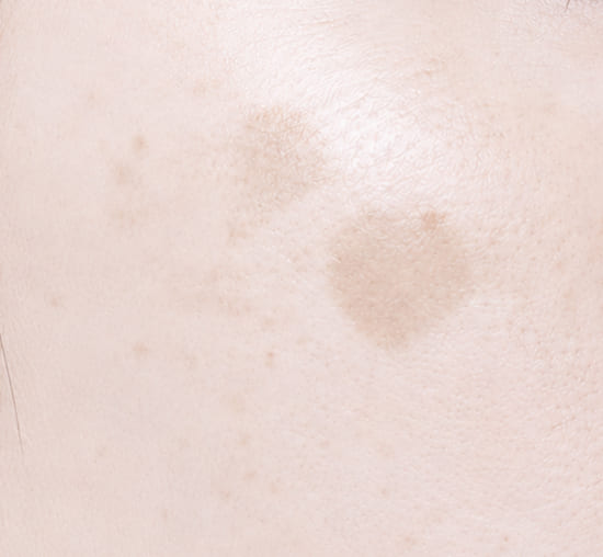 senile pigmentation
