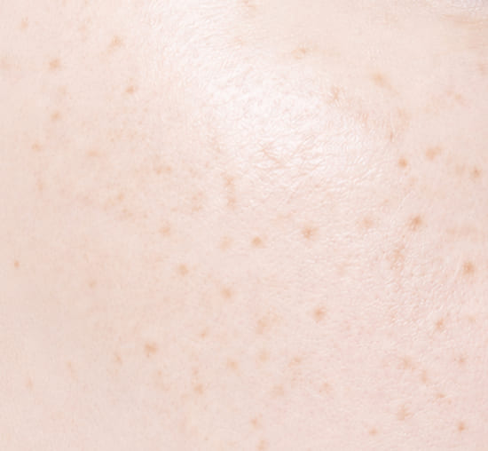 Freckles