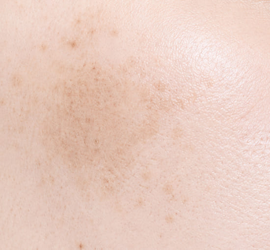 Chloasma