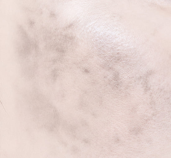 ADM (acquired dermal melanocytosis)