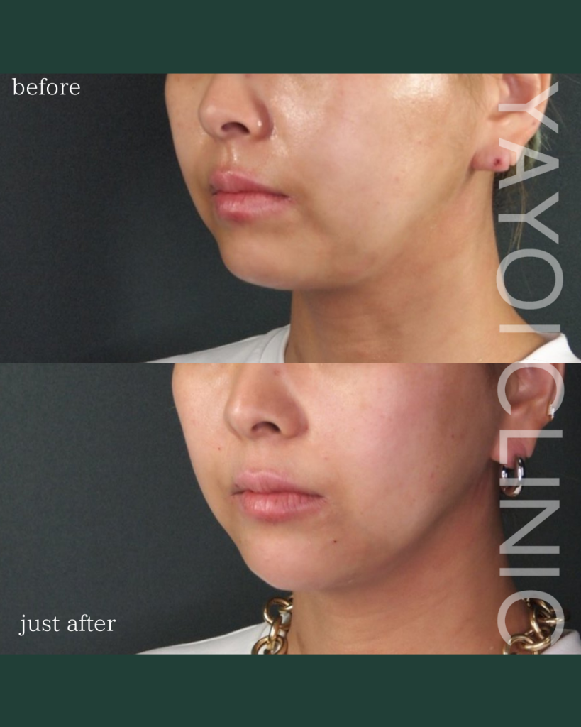 Customized Hyaluronic Acid Injection Whole Face