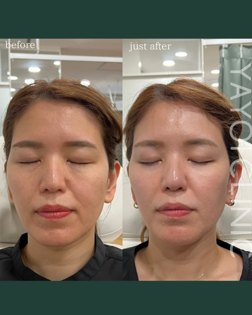 Customized Hyaluronic Acid Injection Whole Face