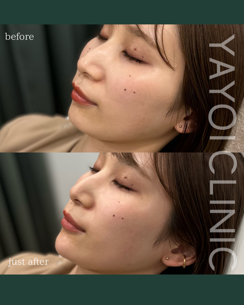Customized hyaluronic acid Facial line and chin