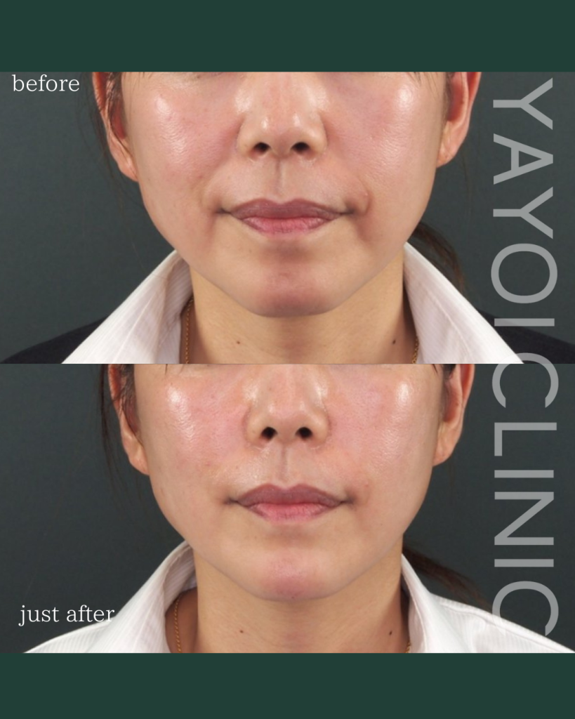 Customized Hyaluronic Acid Injection Lines