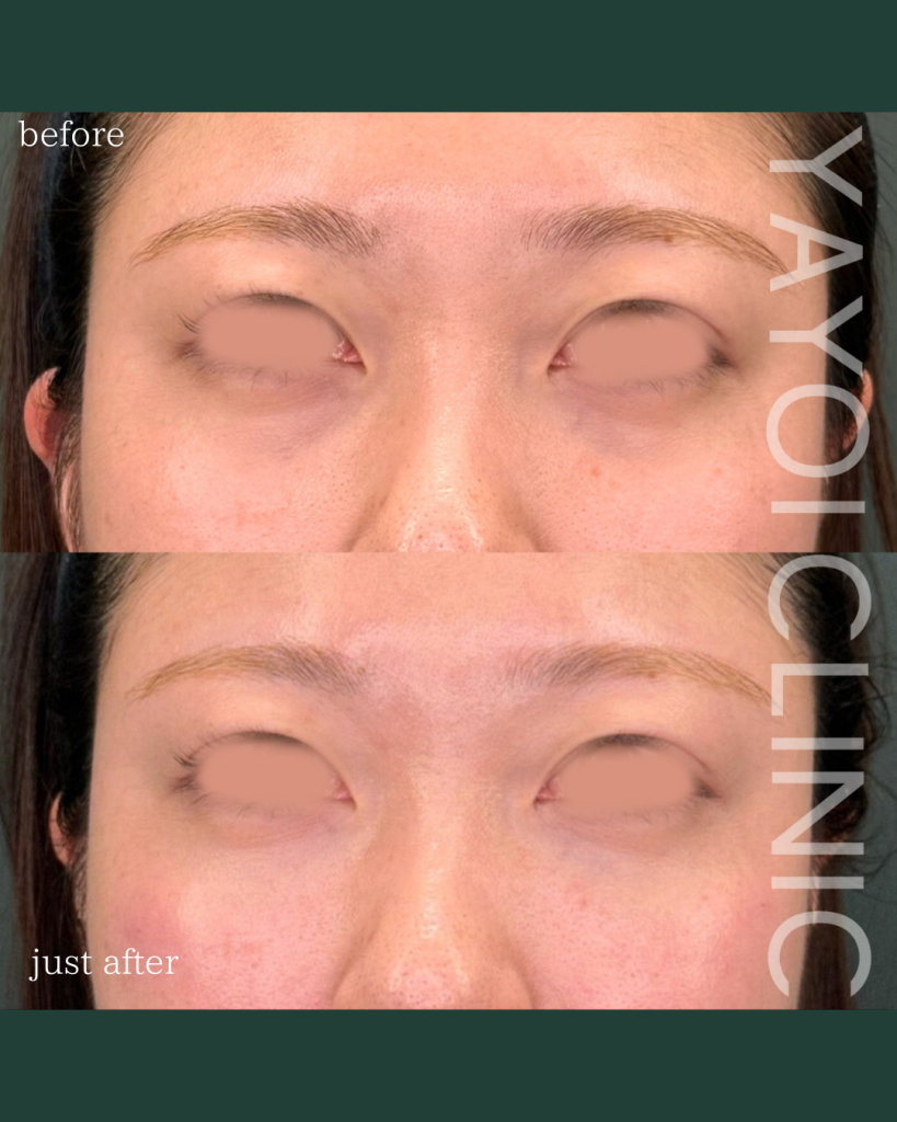 Customized Fillers under the eyes