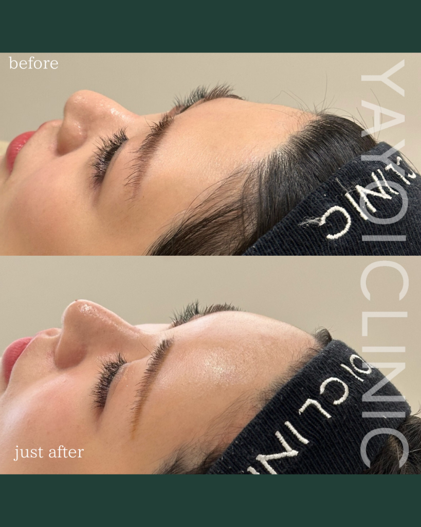 Customized hyaluronic acid injection forehead and temples