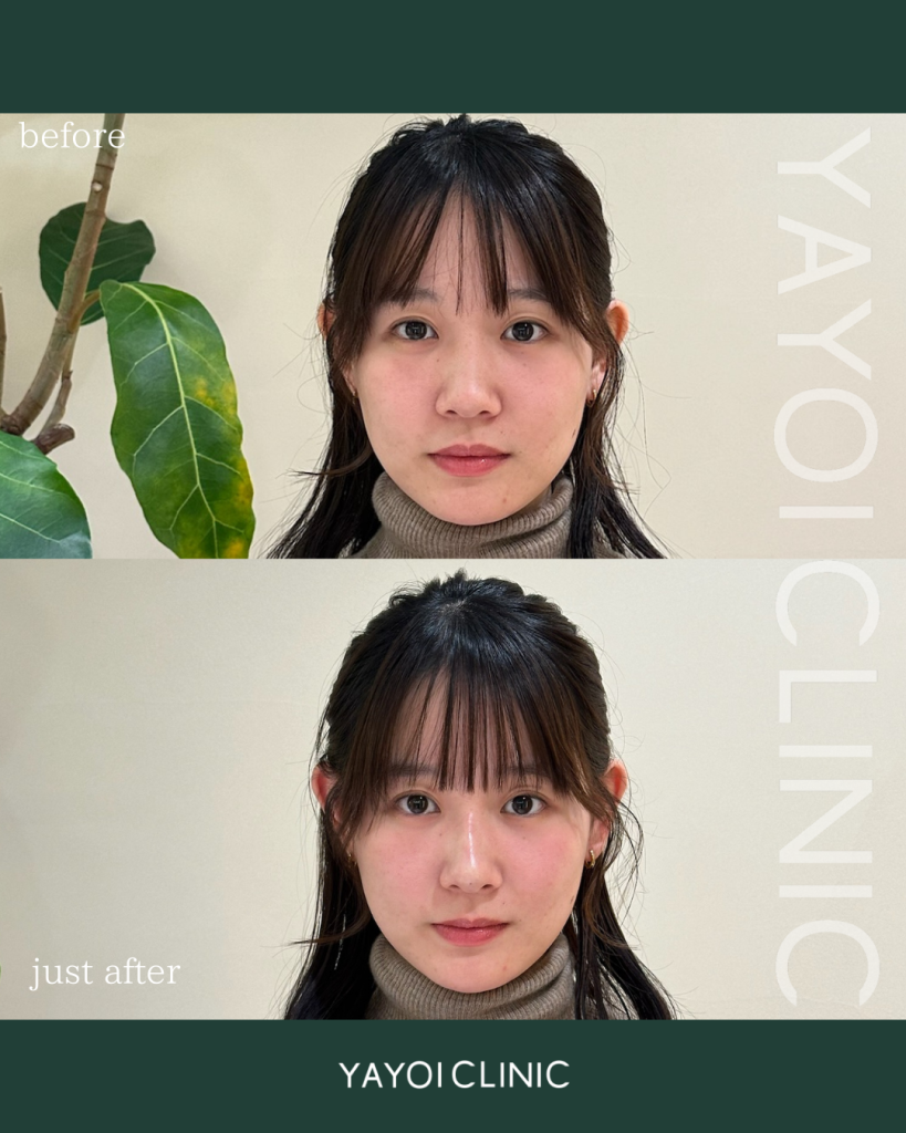 Customized Hyaluronic Acid Injection Nose