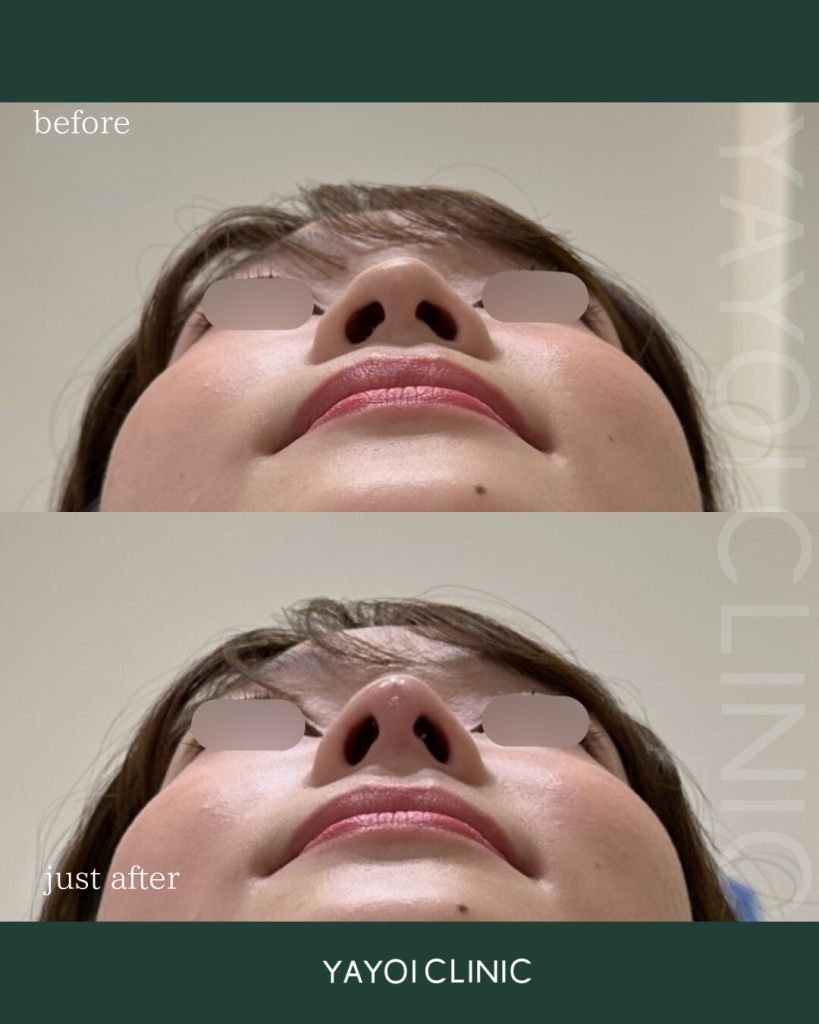 Customized Hyaluronic Acid Injection Nose