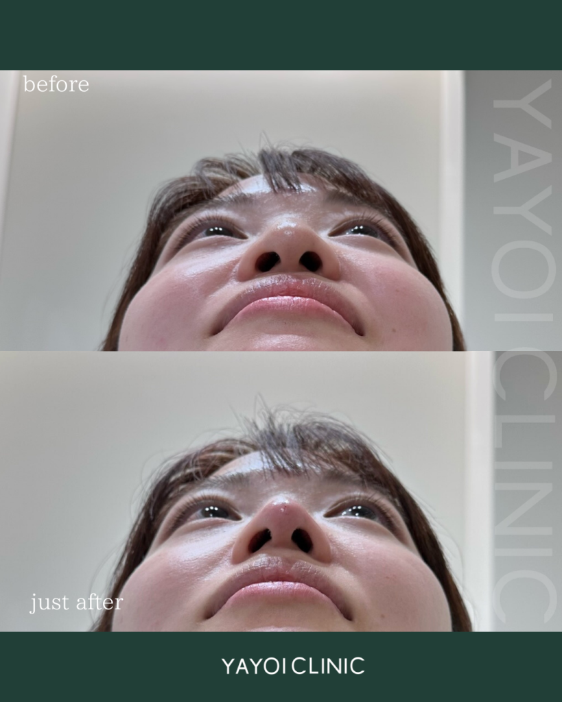 Customized Hyaluronic Acid Injection Nose