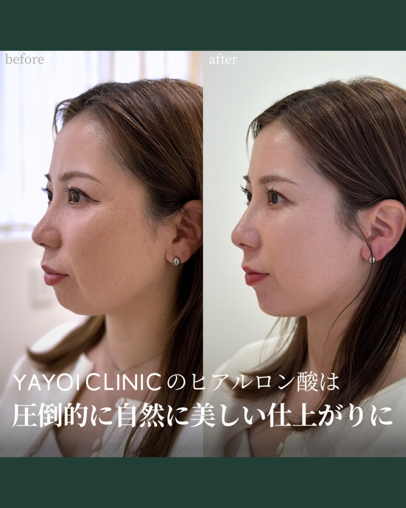 ヒアルロン酸注射