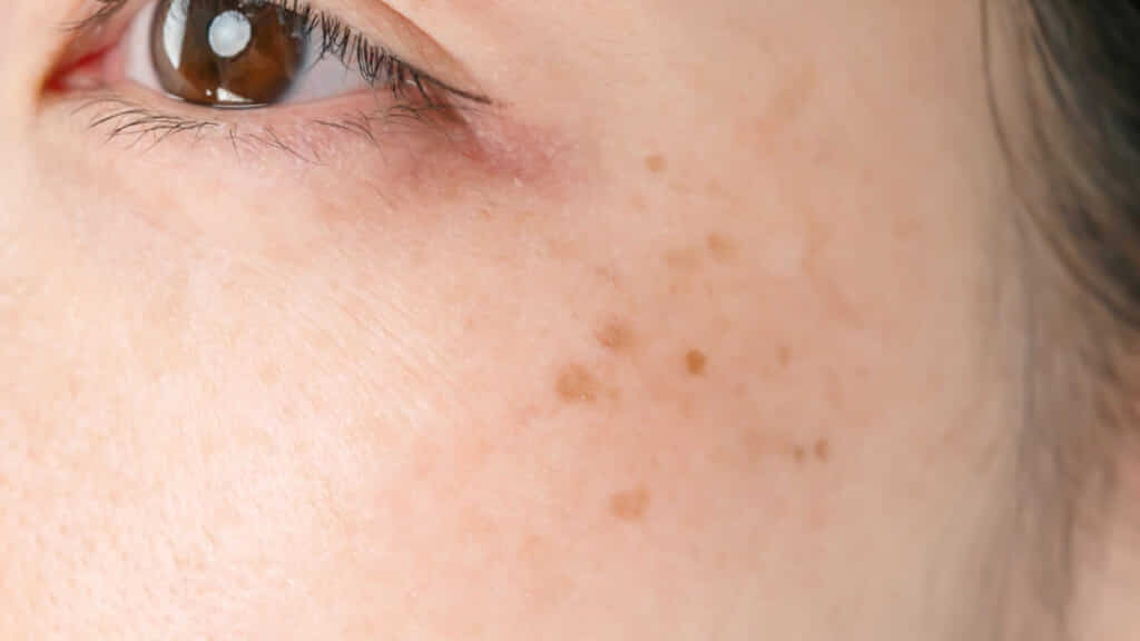 Blemishes, freckles, melasma, ADM