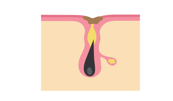 Pores become blocked and sebum builds up.