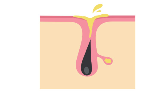 Pores widen and sebum oxidizes