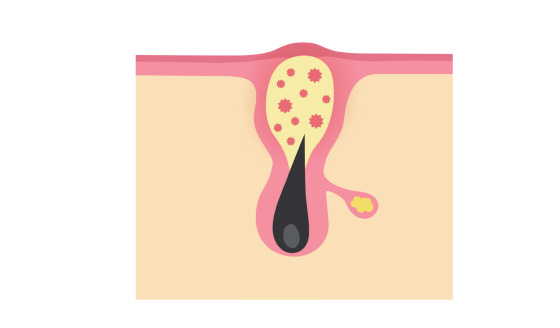 Inflammation by bacteria in pores