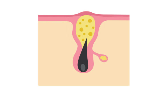  Worsening of inflammation, pus accumulation