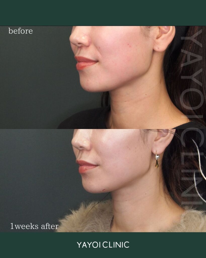 Erabotox + Botox Lift