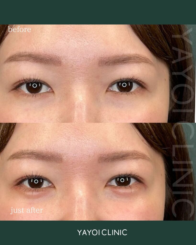 Customized hyaluronic acid injection (tear troughs)