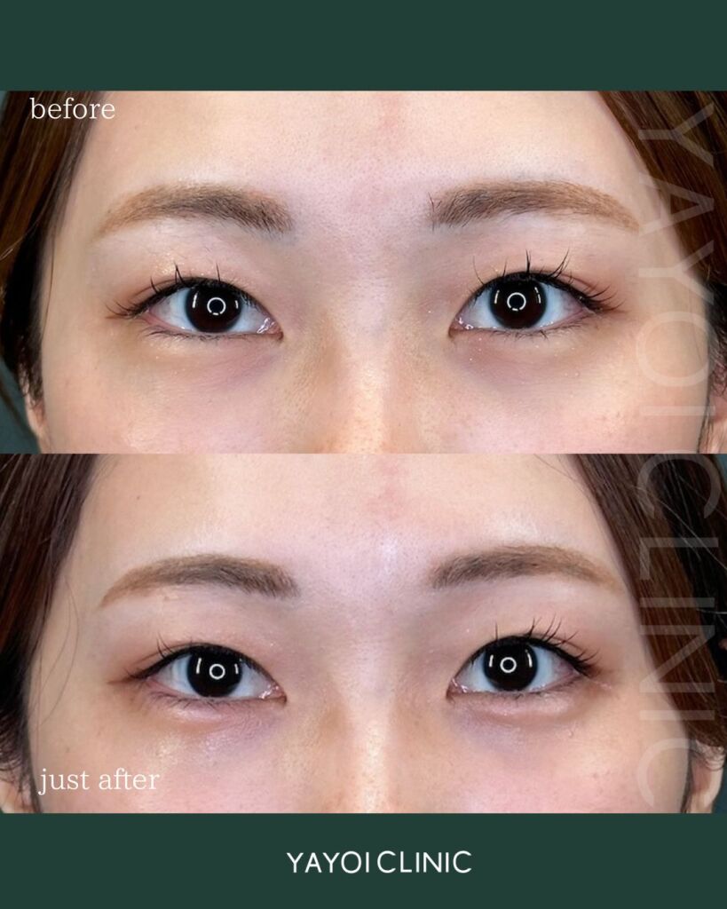 Customized hyaluronic acid injection (tear troughs)