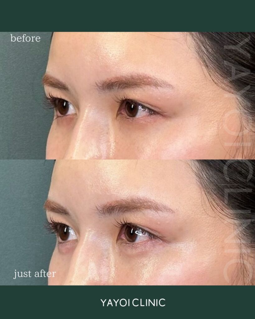 Customized hyaluronic acid injection (tear troughs)