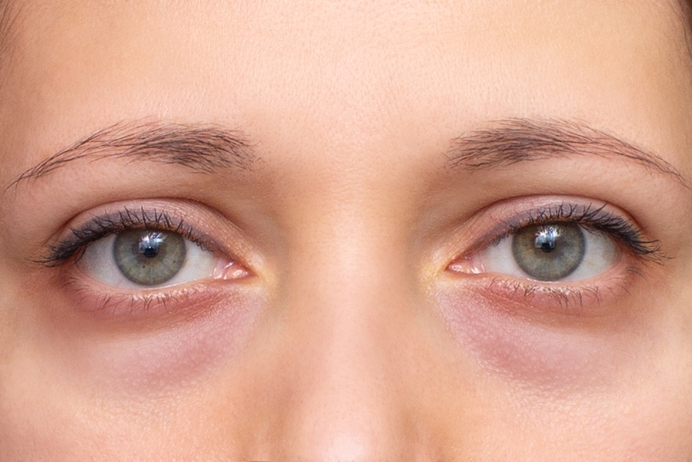 The following are some tips on how to find a clinic in Hiroshima, Japan for hyaluronic acid injections for hollow eyes!