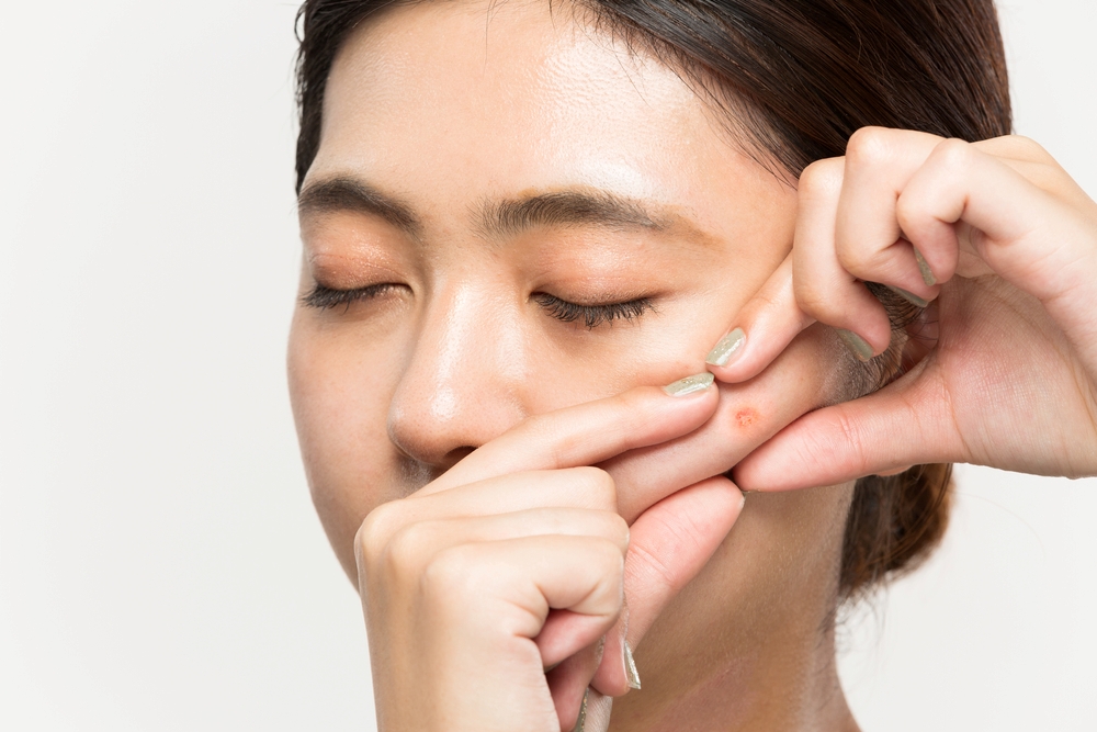 ニキビ痕どうやって治す?セルフケアのコツや向いている美容医療を紹介