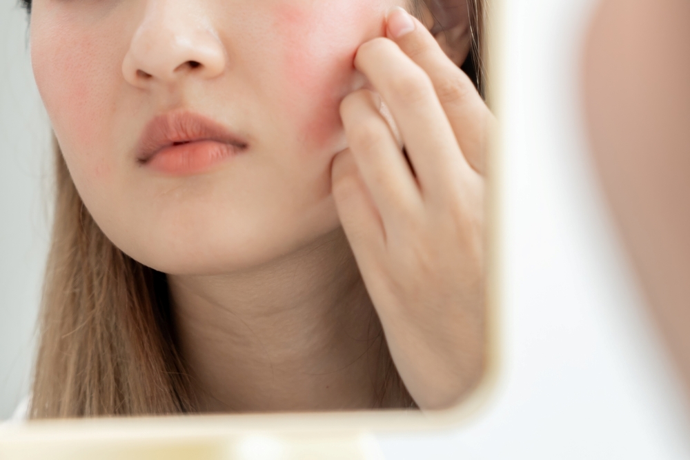 How to get acne scar treatment in Hiroshima? Explanation of treatment methods and post-treatment self-care