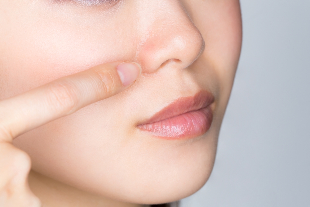 Hyaluronic acid injection into the base of the nasal wings in Hiroshima! Thorough explanation of effects and precautions