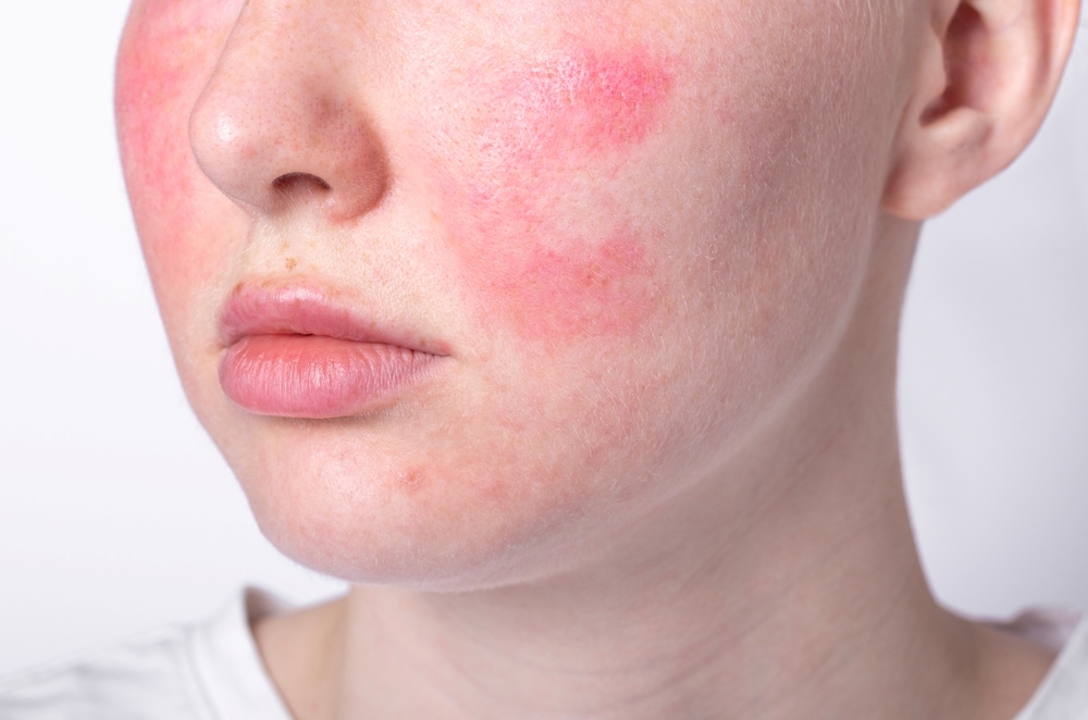 Laser treatment for red face in Hiroshima! Explanation of types of treatment and effects｜Introduction of precautions and key points.