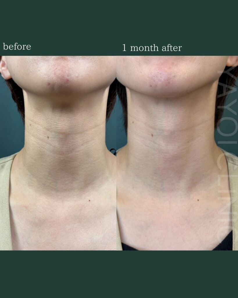 Trifil (neck)