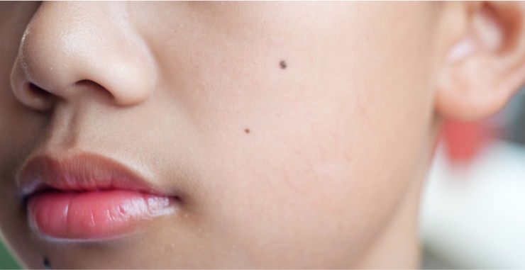 How to choose a clinic for mole removal at a cosmetic dermatology clinic in Hiroshima and what to check