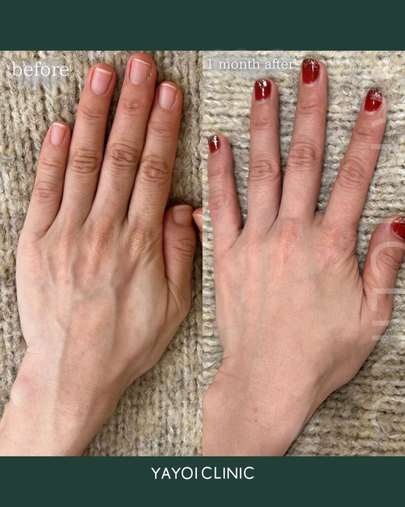Customized hyaluronic acid injection (back of hand)