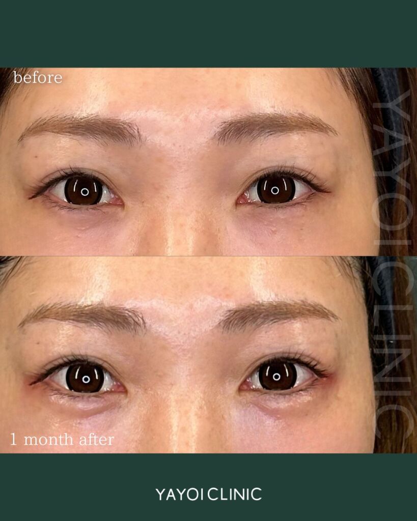 Customized hyaluronic acid injection (tear troughs)