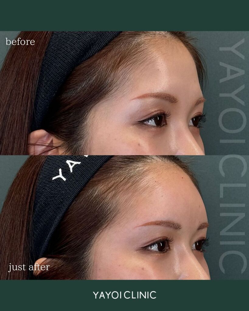 Customized hyaluronic acid injection (forehead and temples)