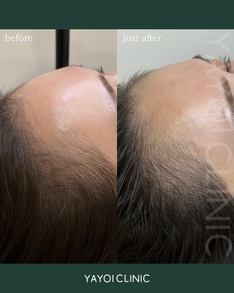 Korean Hairline