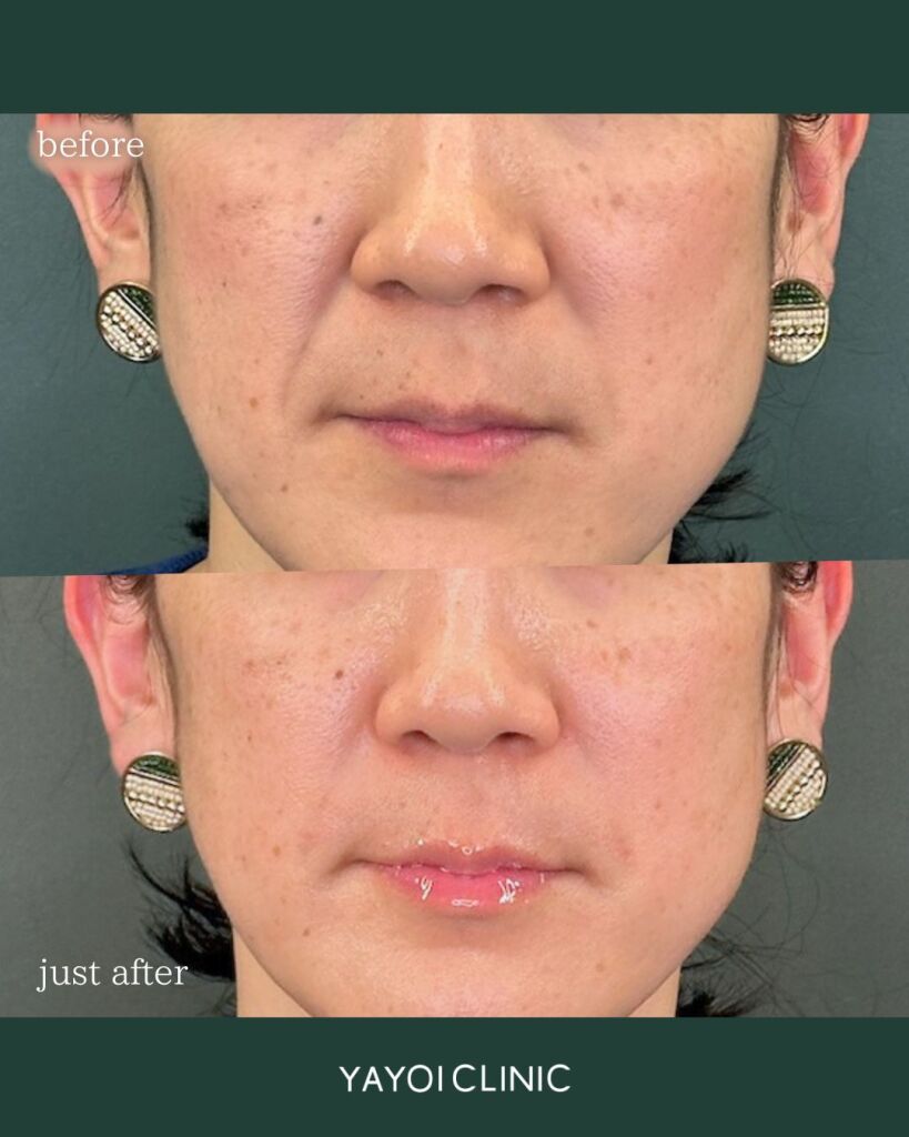Customized hyaluronic acid injection (laugh lines)