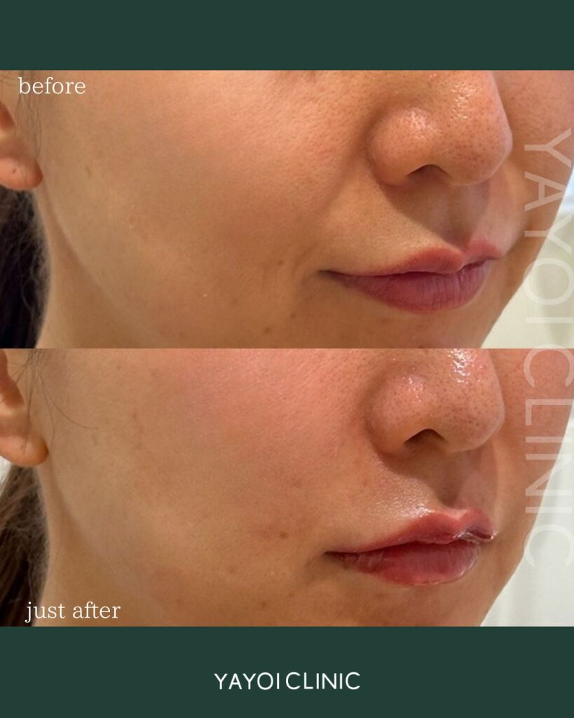 Customized Hyaluronic Acid Injections (Nasal Wings)
