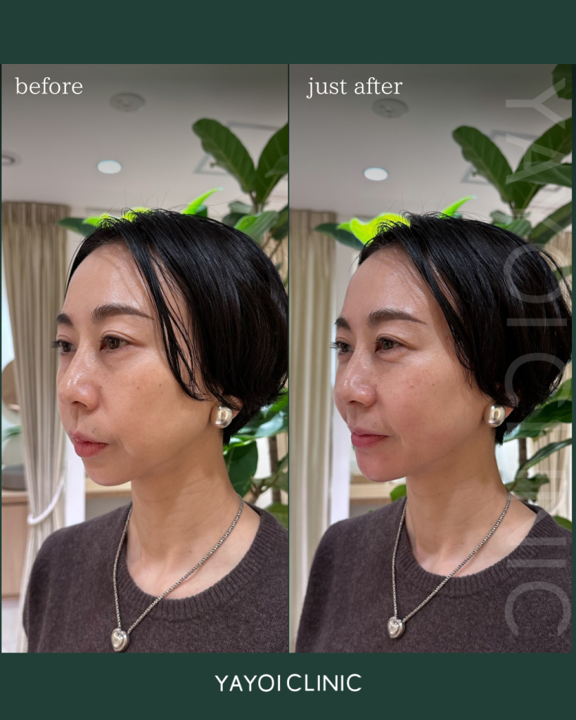 Customized hyaluronic acid injection (chin)