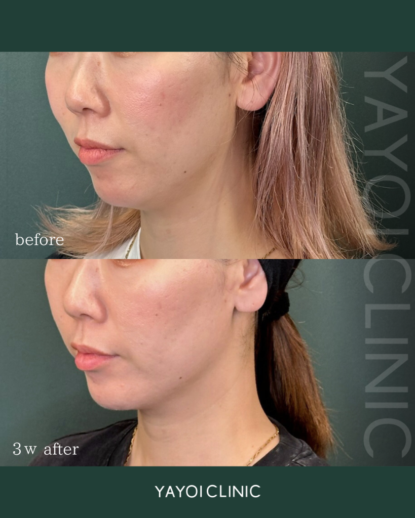 Customized hyaluronic acid injection (chin) and V-line lift