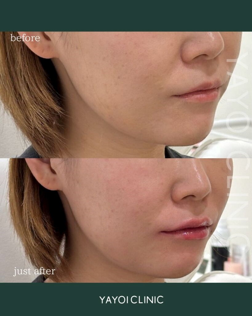 Ideal Lips Achieved with Hyaluronic Acid Lip Injections|Even Beginners Can Understand! Attraction of the procedure