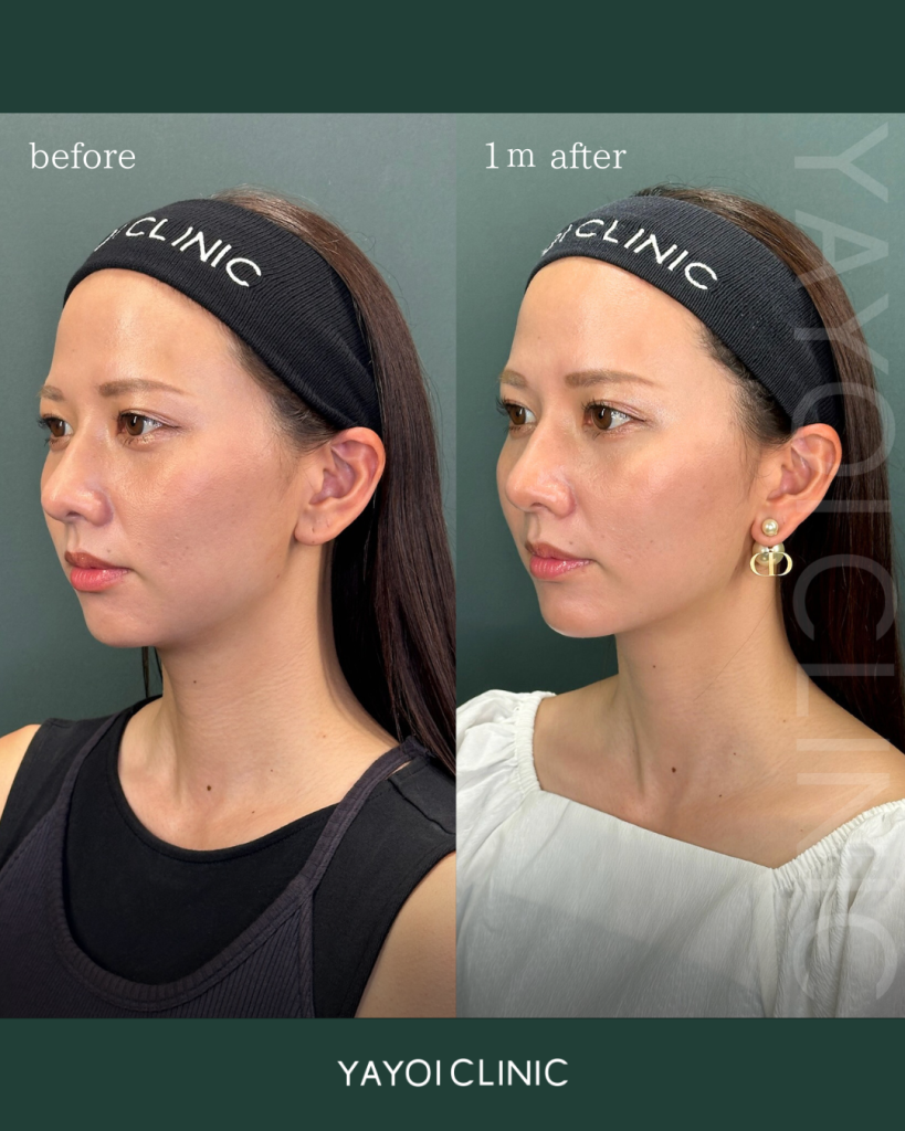 Customized hyaluronic acid injection (chin) and V-line lift