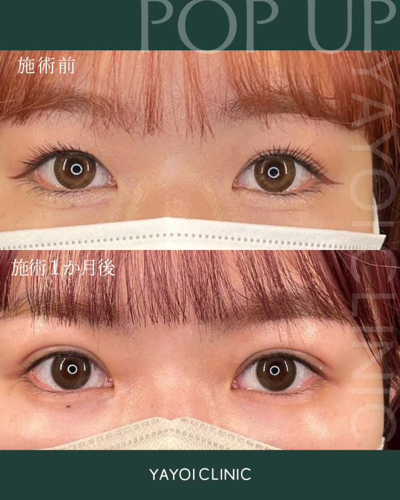 美容外科　二重埋没法(裏留め) B TWICE