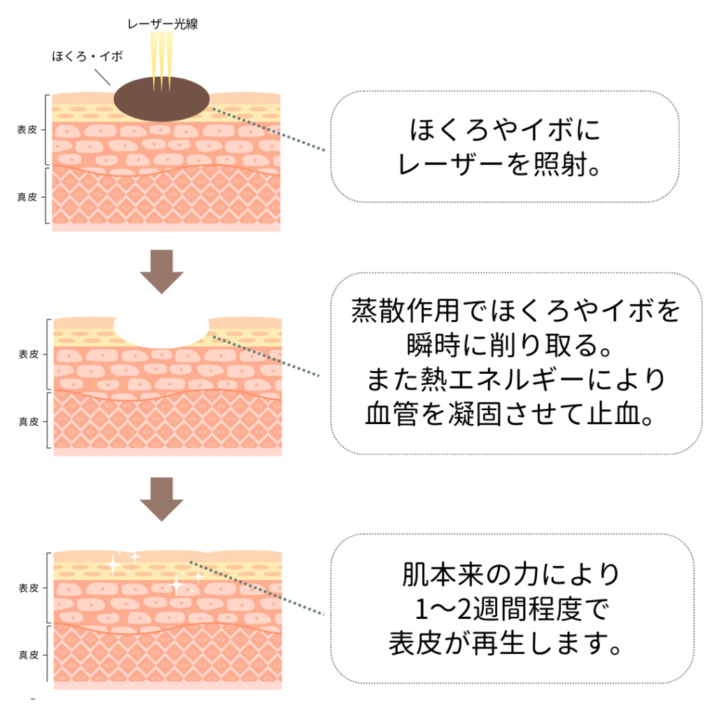 Cosmetic Dermatology Yayoi Clinic for removal of warts in Hiroshima! Explanation of the treatment process