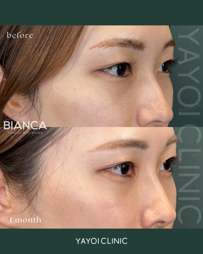 Cosmetic Surgery Dark circles and sagging under eyes (conjunctival blepharoplasty)