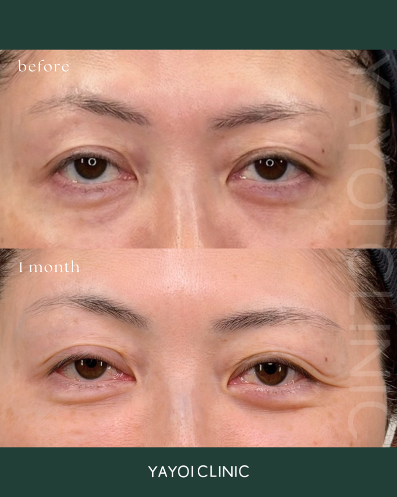 Cosmetic Surgery Sagging and dark circles under the eyes, back hamula procedure
