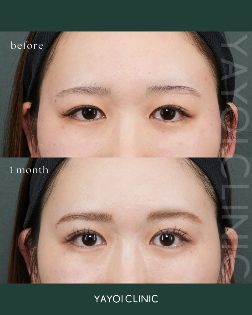 美容外科 自然癒着法