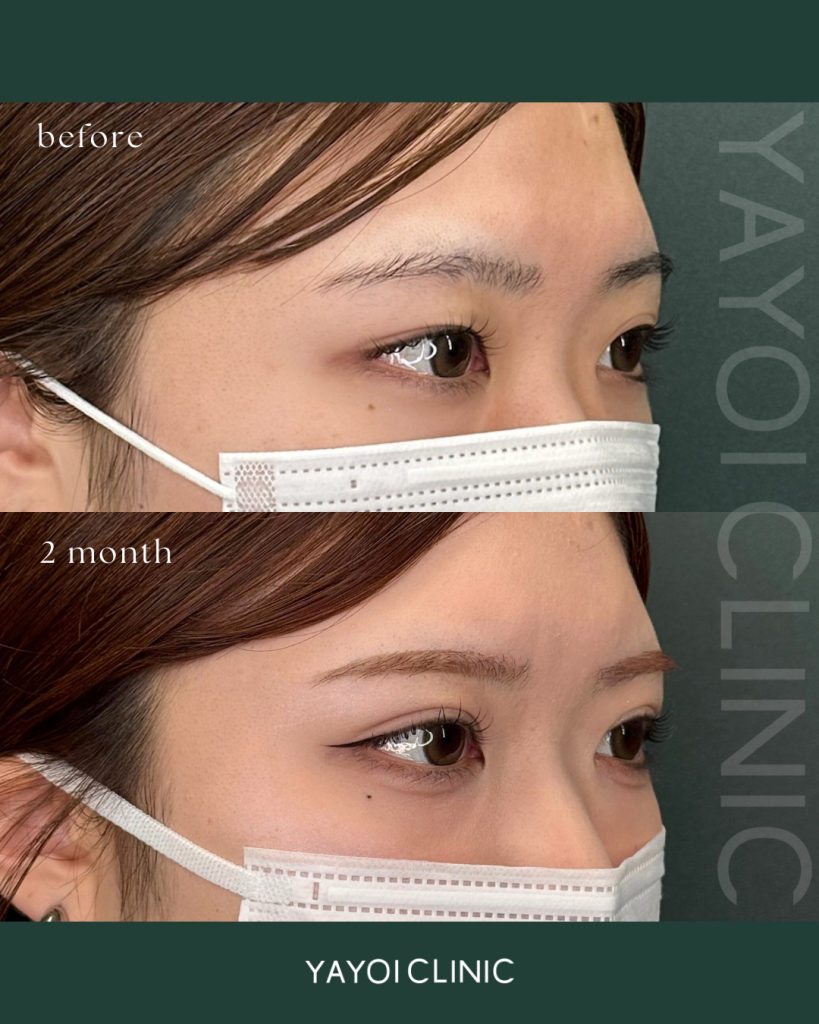 Cosmetic Surgery Double Implantation (4-point clamping)