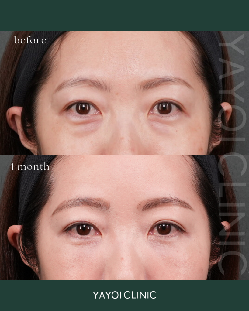 Cosmetic Surgery Dark circles under the eyes sagging removal (condominium dewaxing) + fat injection (under the eyes, gorgonas)