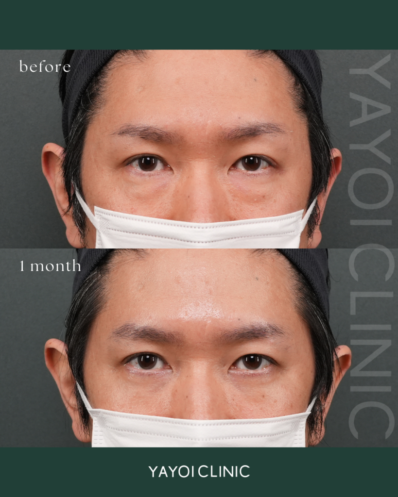 Cosmetic Surgery Sagging dark circles under the eyes (degreasing)