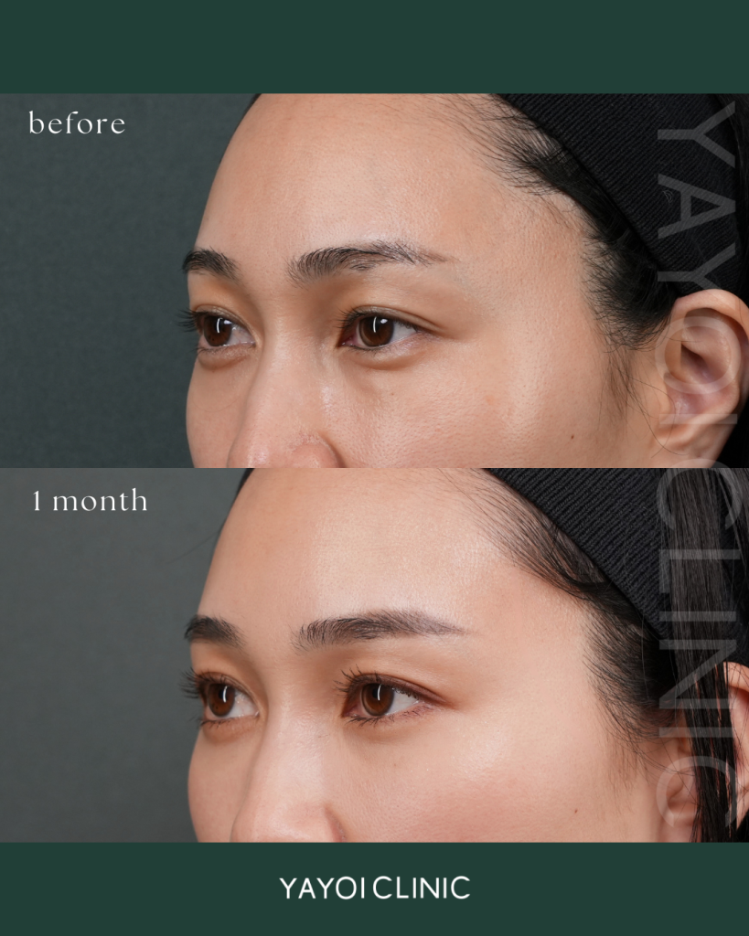 Cosmetic Surgery Sagging and dark circles under the eyes, back hamula procedure