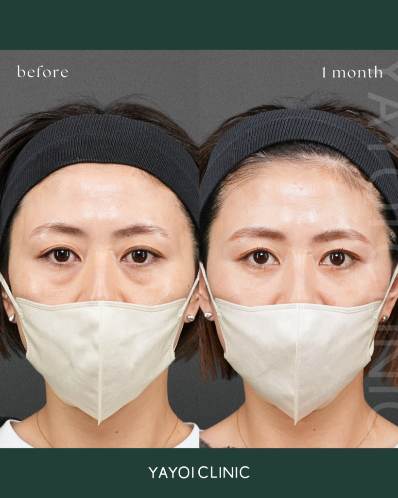 Cosmetic Surgery Sagging and dark circles under the eyes, back hamula procedure
